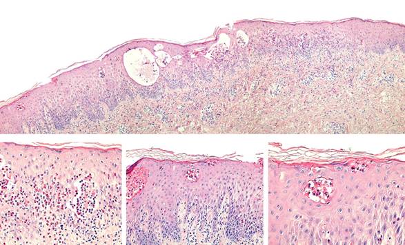 Figura 4. Microfotograf&iacute;as
a peque&ntilde;o aumento (arriba 20X), mediano (abajo izquierda y centro 100X) y gran
aumento (abajo derecha 400X). Se observan algunos queratinocitos necr&oacute;ticos y
exocitosis de eosin&oacute;filos con formaci&oacute;n de colecciones intra epid&eacute;rmicas
caracter&iacute;sticos del estadio I (vesicular) de la incontinencia pigmenti.