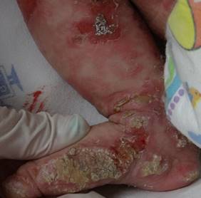 Figura 5. Lesiones en
extremidades a los dos meses de vida.