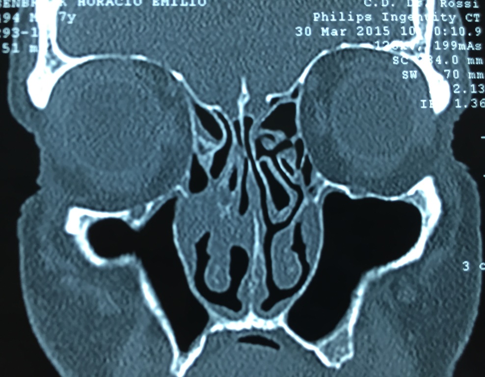Figura
1.
Compromiso de cornete medio y drenajes de meato inferior y medio en tomograf&iacute;a
computarizada.