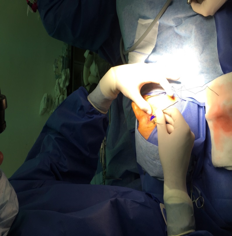 Figura
2.
Transoperatorio de dacriocistorrinostom&iacute;a.