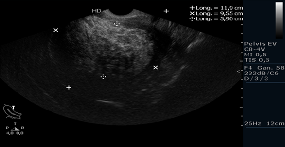Medida
del endometrio por ecografía transvaginal