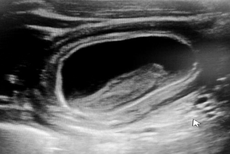 Duplicaci&oacute;n intestinal