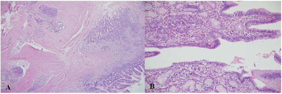 A: se observa la
mucosa g&aacute;strica, la muscular propia y el tejido pancre&aacute;tico ect&oacute;pico. B: mucosa
pil&oacute;rica y gl&aacute;ndulas