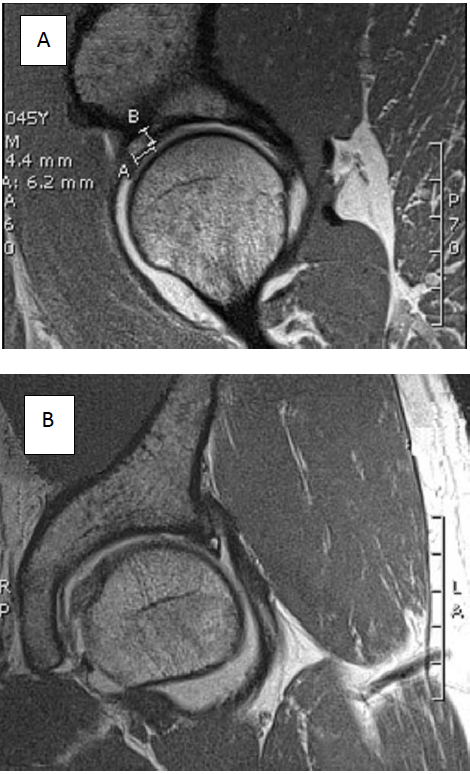 Resonancia
nuclear magnética que muestra quiste del labrum
(A y B)