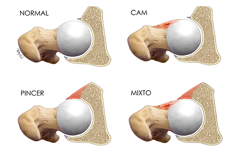 A)
Articulación normal. B) SPFA tipo CAM. C) SPFA tipo pincer. D) SPFA tipo mixto (ver referencia 22)