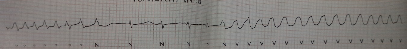 Taquicardia
ventricular polim&oacute;rfica
