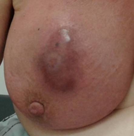 Absceso mamario.