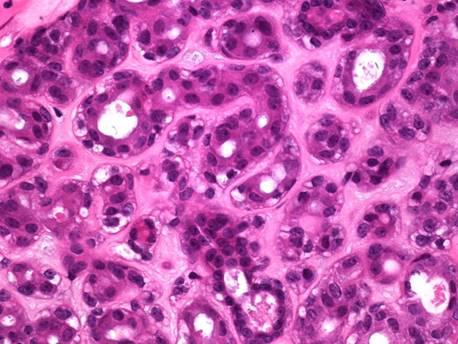 Microfotografia 40x que muestra la proliferación de células mioepiteliales basales con citoplasma claro células claras periféricas y células epiteliales luminales