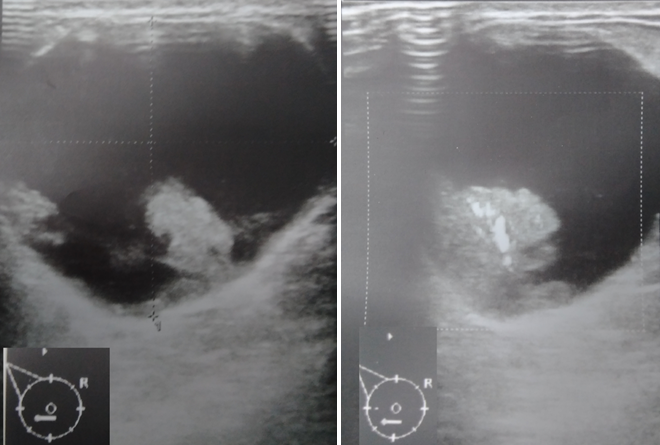 Ecograf�a de mama modo B y doppler a color de lesi�n papilar intraqu�stica