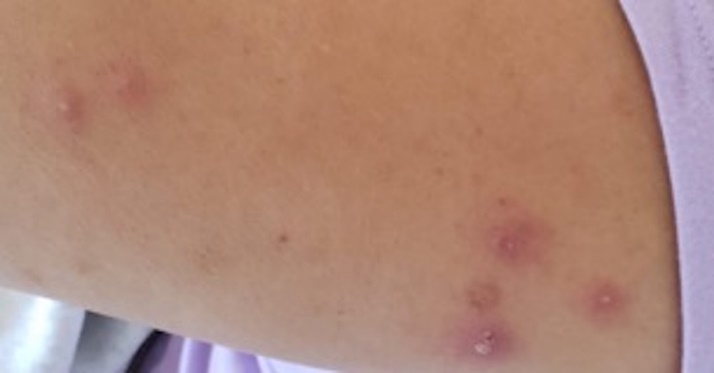 Pioderma gangrenoso pustuloso: m�ltiples p�stulas menores de 0.5 cm de di�metro de base eritematosa en muslo, algunas con costra central.