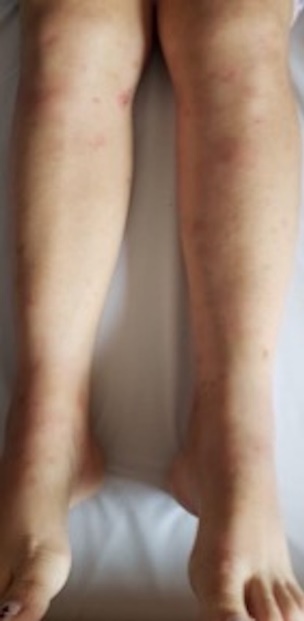 Eritema nodoso: n�dulos eritematosos y placas pardas y eritematosas, algunas excoriadas en �rea pretibial.