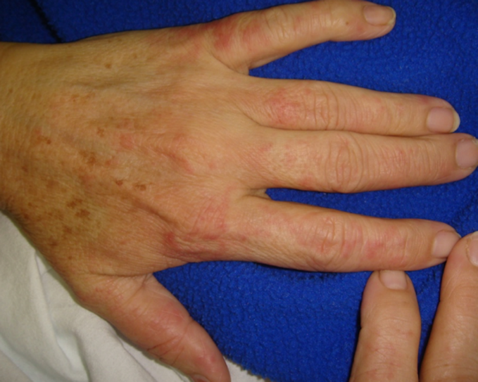 Reacci�n eccematiforme AntiTNF 1: placas eritematosas infiltrada de bordes irregulares y maldefinidos en dorso de mano y dorso de dedos.