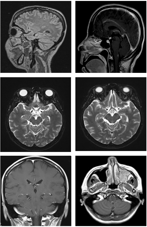 Resonancia magn�tica cerebral.