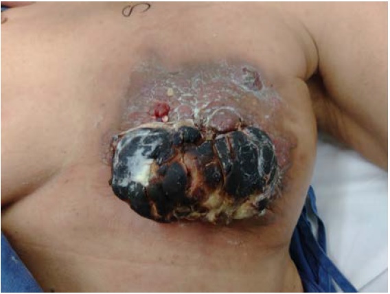 Angiosarcoma de mama izquierda