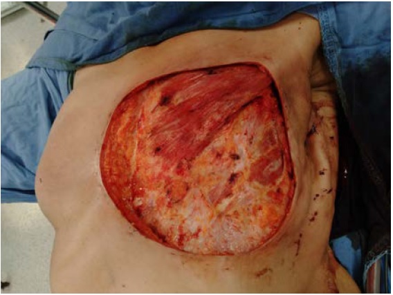 Resección de angiosarcoma de mama izquierda con escisión parcial del músculo pectoral mayor