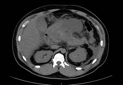 Necrosis pancre�tica del 50% con colecci�n peripancre�tica y l�quido libre en cavidad peritoneal