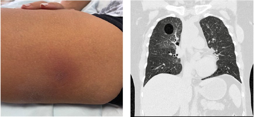 Izquierda). Placas eritematosas y edematosas, mal delimitadas, en muslo derecho. Derecha). TACAR de t�rax: lesiones qu�sticas en el par�nquima pulmonar y nivel hidroa�reo de la lesi�n dominante superior derecha.