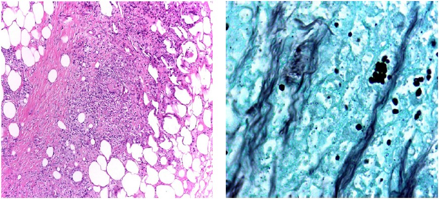 Izquierda). Dermatitis y paniculitis granulomatosa (H&E -10x). Derecha). Tinci�n de plata metenamina que revela levaduras compatibles con Histoplasma spp. (40x).