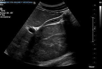 Ultrasonografa de hgado y vas biliares.