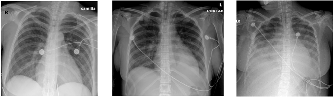 Admission and after intubation chest X-Ray showing mild widespread interstitial infiltrates and blunting of the costophrenic angle (bilateral pleural effusion).