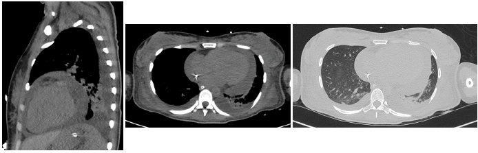 Chest CT showing pericardial and pleural effusion.