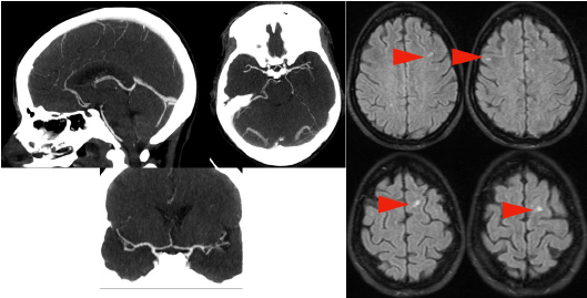 Left: Head MRI with contrast showing right internal carotid, middle cerebral arteries, intracranial vertebral arteries, and posterior cerebral arteries vasculitis (irregularities, narrowing, and stenosis). And Right: Head MRI without contrast showing vasculitis areas (arrows pointing high signal intensity).