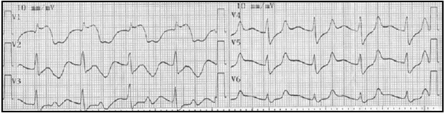 Electrocardiograma de ingreso.