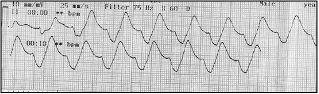 Electrocardiograma de control tomado a los 10 minutos. Onda sinusoidal.