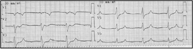 Electrocardiograma posterior a manejo con gluconato de calcio IV. Reversión de onda sinusoidal.
