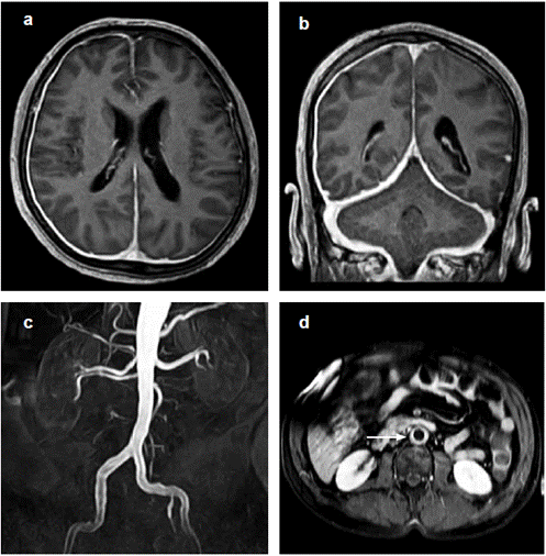a, b.Resonancia magnética cerebral. TI contrastado. Corte transversal y corte coronal. Paquimeningitis difusa supra e infratentorial de predominio derecho. c, d. Angiorresonancia abdominal. Engrosamiento mural circunferencial de la aorta abdominal, en especial de la región infrarrenal, con extensión a las arterias ilíacas comunes demostrando edema y marcado realce poscontraste.