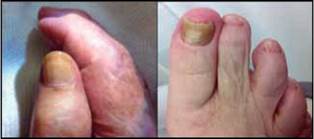 Lesiones pigmentarias, hiperqueratosis y onicolíticas en manos y en pies.