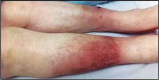 Edema en piernas con compromiso bimaleolar. Nótese en el tercio medio de las piernas los cambios pigmetarios a nivel cutáneo y excoriación en pierna izquierda.