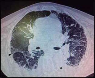 Tomografía axial computarizada de tórax con evidencia de derrame pleural bilateral (*), atelectasiasy compromiso fibrótico intersticial pulmonar.