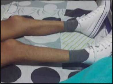 Atrofia muscular marcada como consecuencia de tetraplejia flácida desarrollada por ataque porfírico.