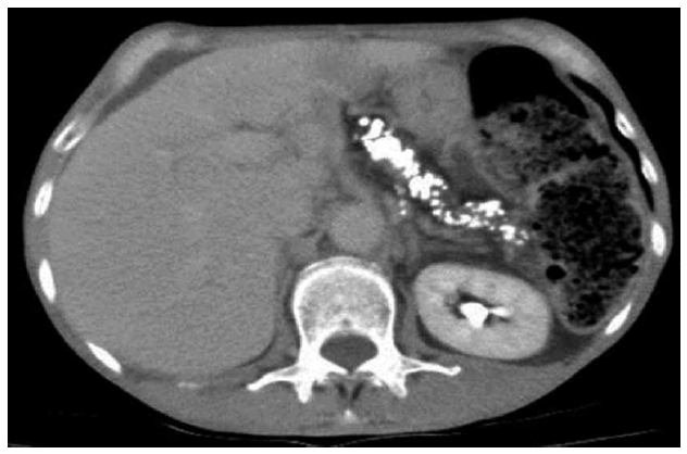 Tomografia de abdomen simple y contrastado, con calcificaciones pancreáticas en relación a proceso inflamatorio