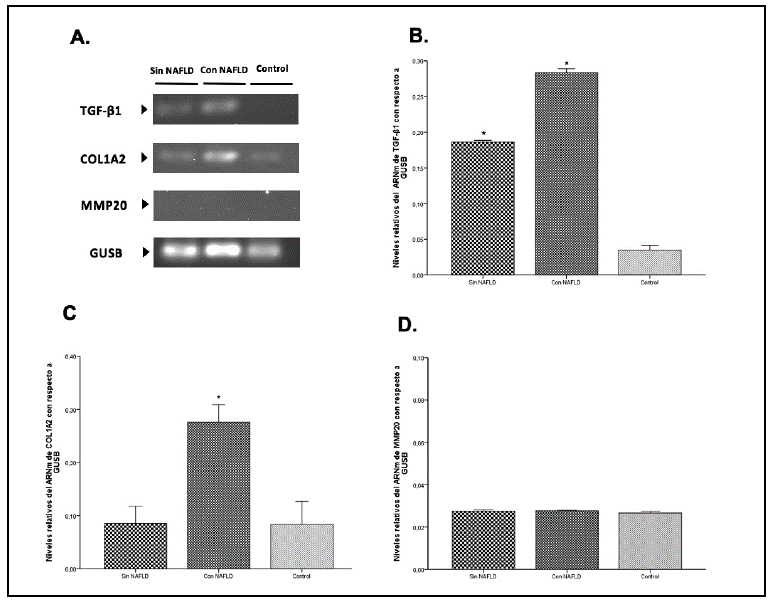 Expresión génica de TGF-/31, COL1A2 Y MMP20 mediante amplificación por PCR convencional en tejido hepático de individuos con factores de riesgo sin desarrollo de NAFLD, de individuos con NAFLD y en control sano. Se utiliza GUSB como gen de referencia.A.Amplificación por PCR en geles de agarosa 1% de TGF-/1, COL1A2 Y MMP20.B.Niveles de expresión relativa del ARNm de TGF-/1 con respecto a GUSB por grupos.C.Niveles de expresión relativa del ARNm de COL1A2 con respecto a GUSB por grupos.D.Niveles de expresión relativa del ARNm de MMP20 con respecto a GUSB por grupos. Los asteriscos indican valores de p<00,05 al comparar los grupos Sin NAFLD / Con NAFLD frente al control.