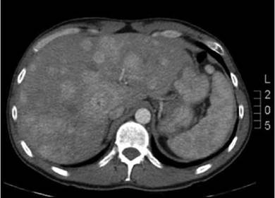 Escintigrafía con receptores de somaatostatina (octreoscan).