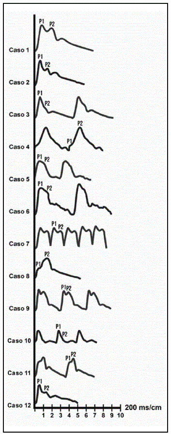 Casos. Trazos de onda HTA.