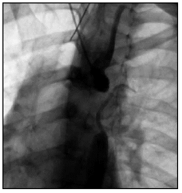 Aortograma: Interrupci&oacute;n del arco a&oacute;rtico con segmento desconectado de cerca de 4 cm, desde la aorta transversa a la aorta descendente, con compromiso de la subclavia izquierda que se encuentra ocluida. Colaterales arterio-arteriales muy abundantes.