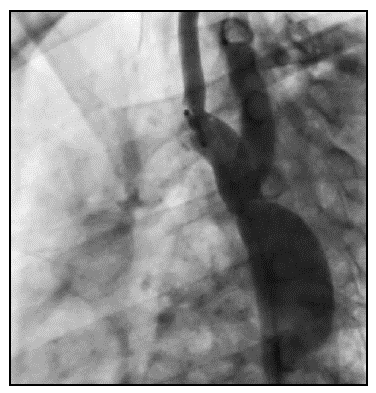 Aortograma: Se evidencia la correcci&oacute;n de la coartaci&oacute;n. A pesar de no tener el mismo di&aacute;metro de la aorta descendente, el di&aacute;metro es mayor y hay un menor gradiente.
