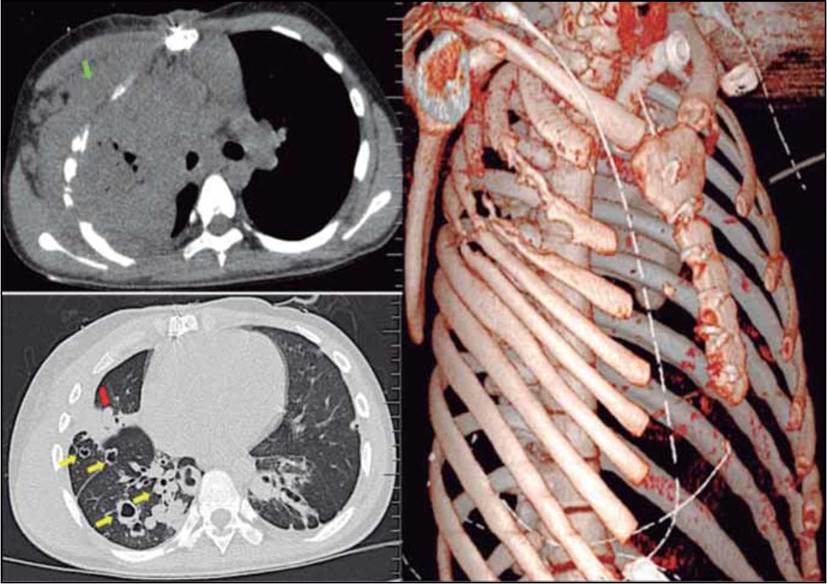 En la imagen superior izquierda se observan hallazgos compatibles con empiema at necesitatis (flecha verde): compromiso pulmonar (absceso l&oacute;bulo superior) con extensi&oacute;n a tejidos blandos de la pared tor&aacute;cica dada por p&eacute;rdida del plano graso entre cavidad pleural y la pared del t&oacute;rax acompa&ntilde;ada de destrucci&oacute;n de arcos costales 2, 3, 4 y 5 secundario a osteomielitis por extensi&oacute;n del proceso pulmonar descrito (imagen derecha, reconstrucci&oacute;n 3D). En la imagen inferior izquierda se observan m&uacute;ltiples bronquiectasias de paredes gruesas acompa&ntilde;adas de m&uacute;ltiples lesiones nodulares y qu&iacute;sticas (flechas amarillas) y un &aacute;rea consolidativa que compromete segmento lateral de l&oacute;bulo medio del pulm&oacute;n derecho (flecha roja).