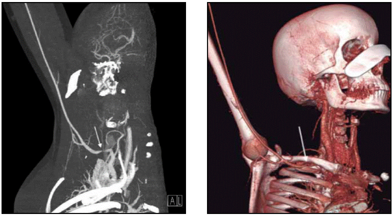 . S&iacute;ndrome del estrecho tor&aacute;cico superior de origen vascular y estenosis de la arteria subclavia derecha.
