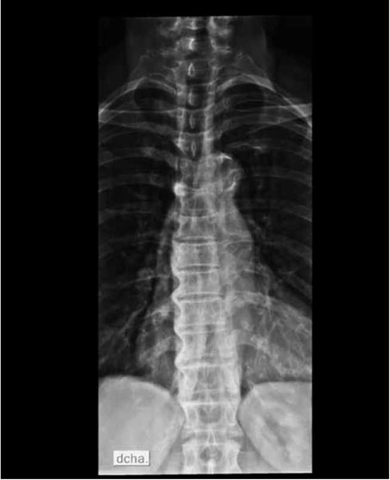 Radiografía de tórax AP nótese la calcificación únicamente en el lado derecho típica del DISH.