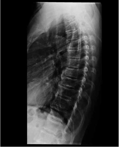 Radiografía lateral de tórax nótese las calcificaciones anteriores burdas en columna con un discreto espacio radiolucido entre éstas y los cuerpos vertebrales.