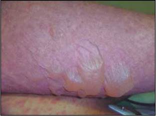 Síndrome de Stevens Johnson. Ampollas flácidas sobre una base eritematosa y edematosa comprometiendo el antebrazo. Nótese además las máculas eritematosas y violáceas afectando el pecho.
