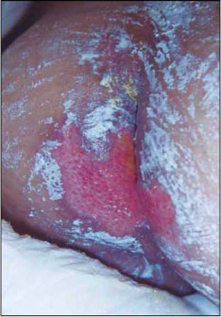 Dermatitis de contacto a pegamento de electrodos. Placas anular y numular eritematosas coalescentes, bien delimitadas que comprometen región torácica y aparecen en sitio de contacto a electrodos.