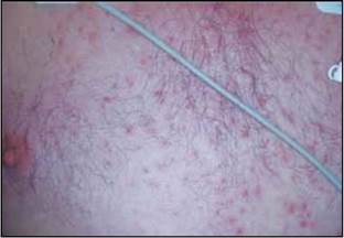 Foliculitis. Múltiples pápulas eritematosas foliculares y escasas pústulas afectando el tórax anterior.