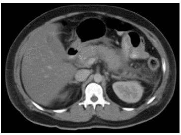 Diffuse increase in pancreatic size, with irregular borders and heterogenous attenuation.