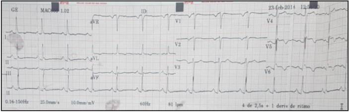 The admission electrocardiogram showed a sinus rhythm with a normal QRS electrical axis, ST elevation on V5-V6, and inverted T wave on precordial V4 and V5 with signs suggestive of left ventricular overload; the remaining leads were within normal limits.