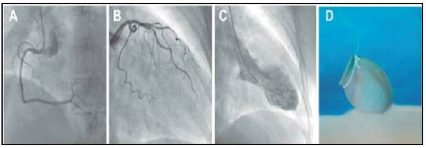 Catheterization. A) Hemodynamic image showing the right coronary without obstruction during angiography. B) Hemodynamic image show ing the left coronary without obstruction during angiography. C) Hemodynamic image showing left ventriculography with an image of apical ballooning suggestive of takotsubo. D) Picture of a traditional Japanese takotsubo pot for catching octopuses.